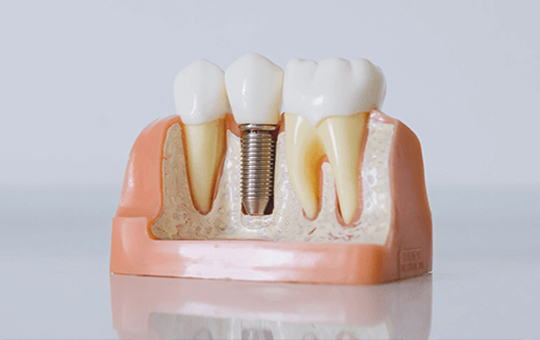 Implantologie Modell von Zähnen